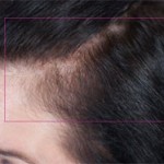 Nutrafol Vitamins for Hair Growth Before and After Pictures Charlotte, NC