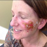 Actinic Keratosis Before and After Pictures Charlotte, NC