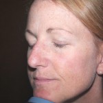 Actinic Keratosis Before and After Pictures Charlotte, NC