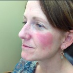Actinic Keratosis Before and After Pictures Charlotte, NC