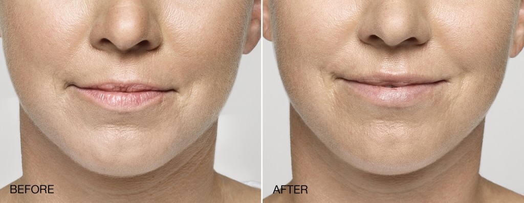 Restylane Before and After Pictures Charlotte, NC