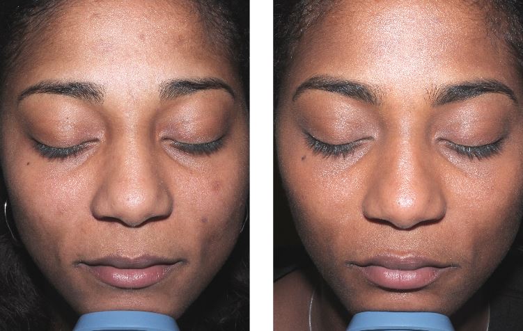 Chemical Peels Before and After Pictures Charlotte, NC