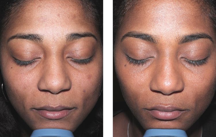 Chemical peels from a dermatologist