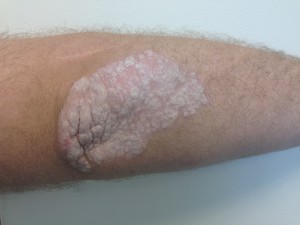 Psoriasis Before and After Pictures Charlotte, NC
