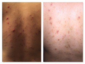 Microneedling Before and After Pictures Charlotte, NC