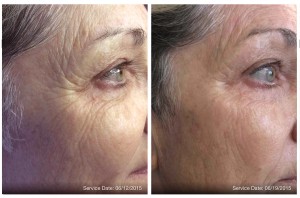 Microneedling Before and After Pictures Charlotte, NC