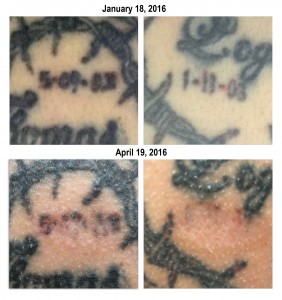 Microneedling Before and After Pictures Charlotte, NC
