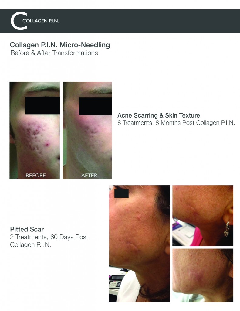 Microneedling Before and After Pictures Charlotte, NC