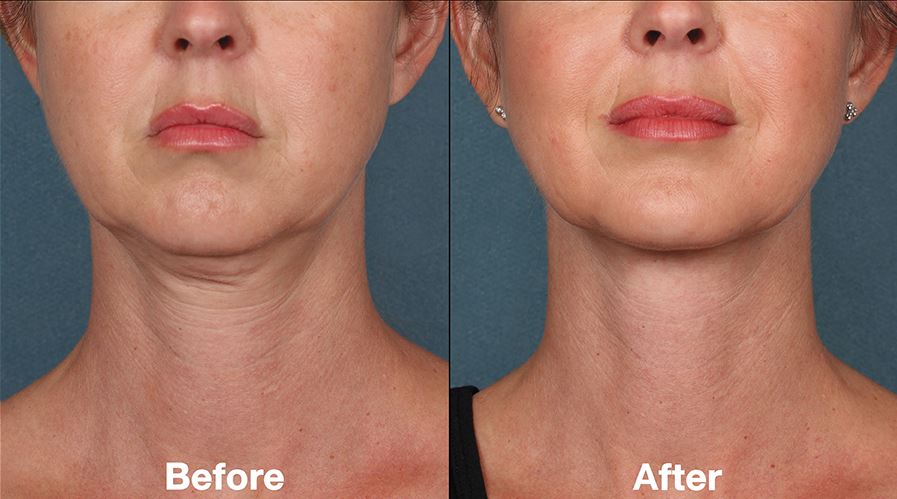 Kybella Before and After Pictures Charlotte, NC