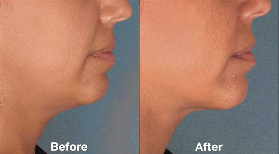 Before And After Pictures Of Kybella™ In Charlotte Nc Darst