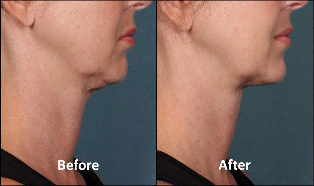 Kybella Before and After Pictures Charlotte, NC