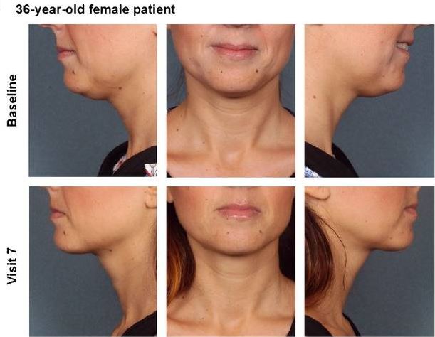 Kybella Before and After Pictures Charlotte, NC