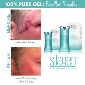 Silagen for Scar Management in Charlotte, NC