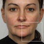 NuFACE® Facial Toning in Charlotte, NC
