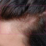 Nutrafol Vitamins for Hair Growth Before and After Pictures Charlotte, NC