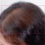 Nutrafol Vitamins for Hair Growth Before and After Pictures Charlotte, NC