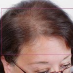 Nutrafol Vitamins for Hair Growth Before and After Pictures Charlotte, NC