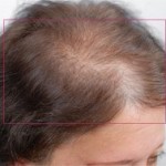 Nutrafol Vitamins for Hair Growth Before and After Pictures Charlotte, NC