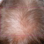 Nutrafol Vitamins for Hair Growth in Charlotte, NC