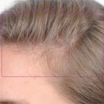 Nutrafol Vitamins for Hair Growth Before and After Pictures Charlotte, NC