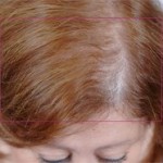 Nutrafol Vitamins for Hair Growth Before and After Pictures Charlotte, NC