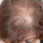 Nutrafol Vitamins for Hair Growth Before and After Pictures Charlotte, NC