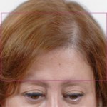 Nutrafol Vitamins for Hair Growth Before and After Pictures Charlotte, NC