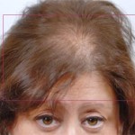 Nutrafol Vitamins for Hair Growth Before and After Pictures Charlotte, NC