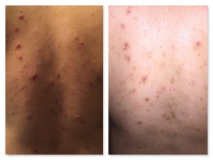 Microneedle Before and After Pictures Charlotte, NC