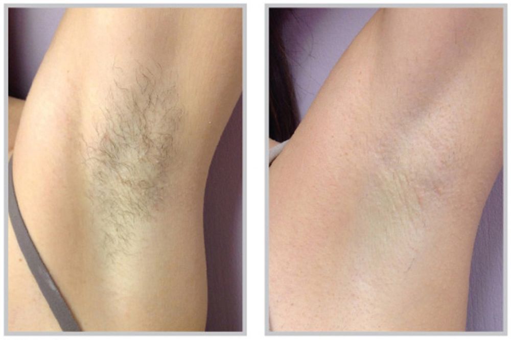 Laser Hair Reduction in Charlotte, NC | Darst Dermatology: Charlotte  Dermatologist